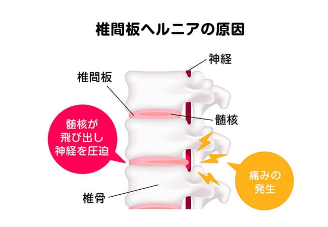 【手・腕のしびれを伴う痛み】頚椎椎間板ヘルニア
