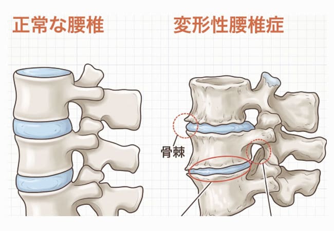 【加齢による腰の痛み】変形性腰椎症(へんけいせいようついしょう)