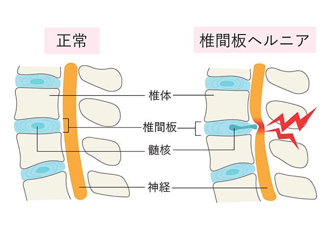【足のしびれを伴う強い痛み】腰椎椎間板ヘルニア