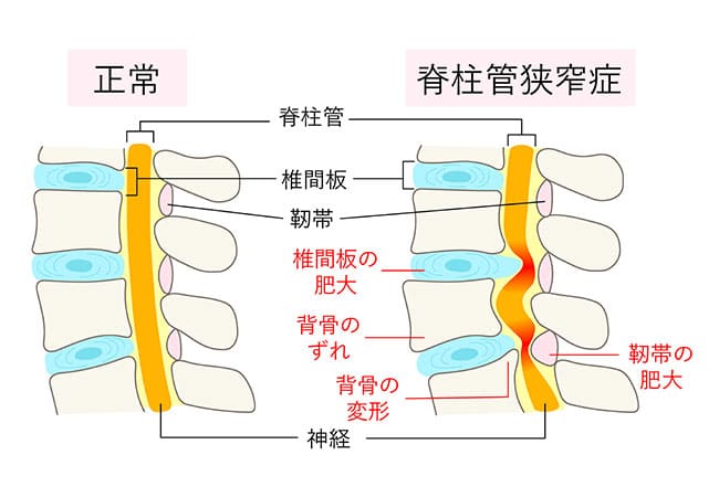 【歩くと足が痛む・しびれる】腰部脊柱管狭窄症(ようぶせきちゅうかんきょうさくしょう)