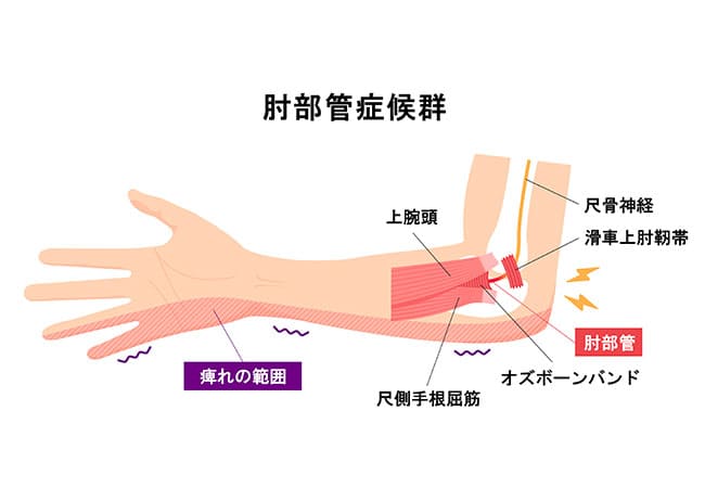 【薬指・小指がしびれる】肘部管症候群(ちゅうぶかんしょうこうぐん)