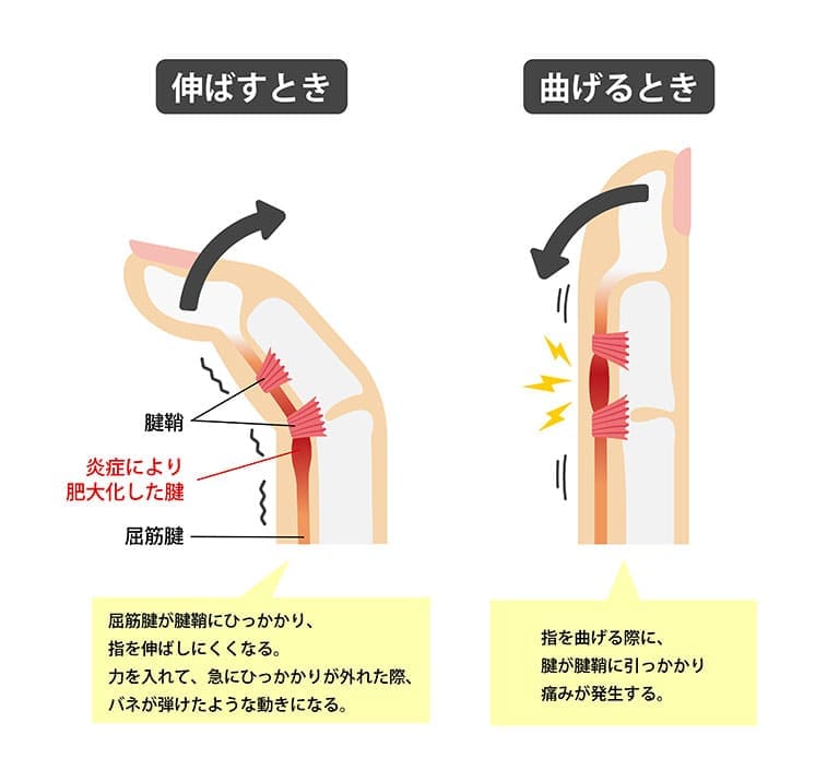 【指の引っかかり・痛み】腱鞘炎（ばね指）