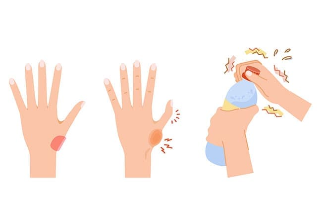 【親指の付け根の痛み】母指CM関節症（ぼしCMかんせつしょう）
