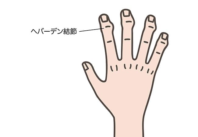 【第一関節の痛み・変形】ヘバーデン結節（へばーでんけっせつ）