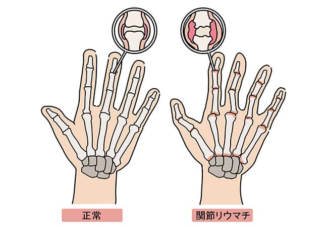 【全身の関節の腫れ・朝のこわばり】関節リウマチ（かんせつりうまち）