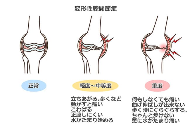 【足の付け根の痛み・動きの制限】変形性股関節症（へんけいせいこかんせつしょう）