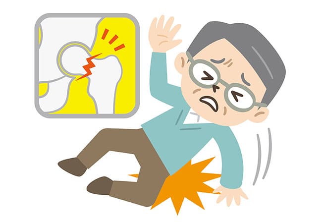 【転倒後の歩行困難】大腿骨近位部骨折（だいたいこつきんいぶこっせつ）