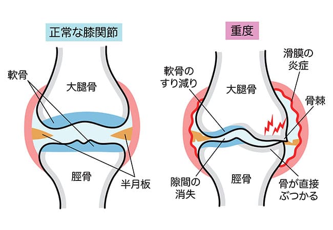【階段の上り下りや動き始めが痛む】変形性膝関節症（へんけいせいひざかんせつしょう）