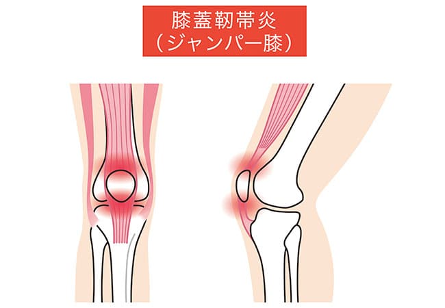 【お皿周りの痛み・跳躍時の痛み】膝蓋靭帯炎（ジャンパー膝）
