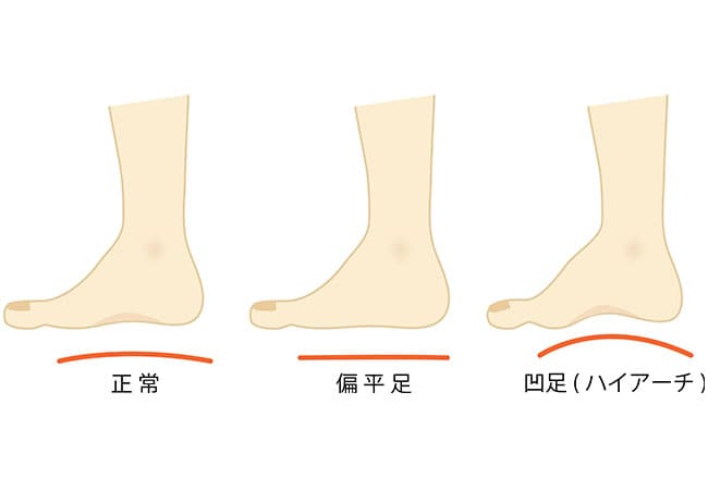 【土踏まずがなくなった足】扁平足（へんぺいそく）
