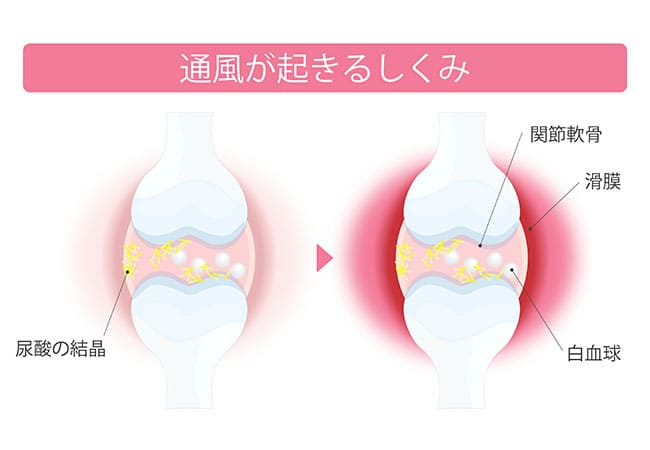 【突然の激痛・腫れ】痛風（つうふう）