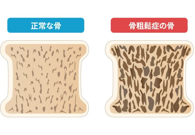 正常な骨と骨粗鬆症の骨の違いイラスト